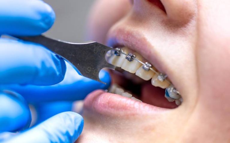 Is It Time To Get Your Teeth Straightened